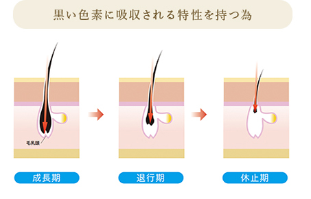 毛抜きや機械で抜く